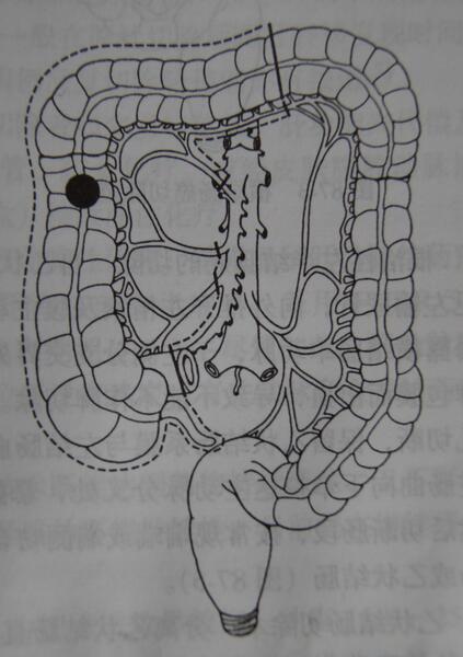 结肠腺癌手绘图片