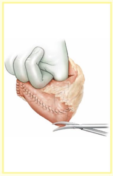 原位回肠新膀胱_膀胱癌_治疗方法_治疗方式 - 好大夫在线