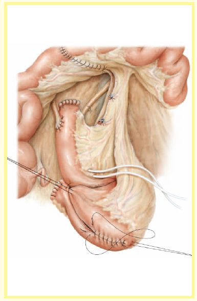 原位回肠新膀胱