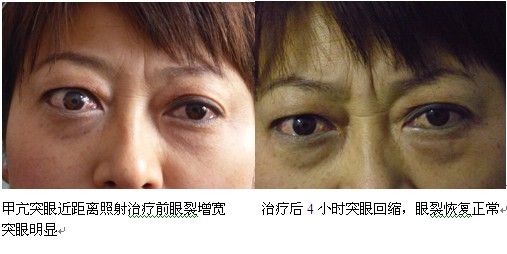 核医学治疗甲亢性突眼前后对比(山东青岛)