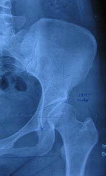 a:术前ce角=18°,ac角=20°,sharps角=44