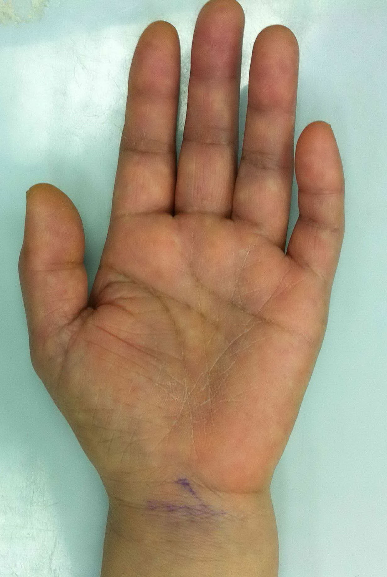 患者女性,左手大鱼际肌肉萎缩三个月,左手前三个半手指麻木,疼痛,手指
