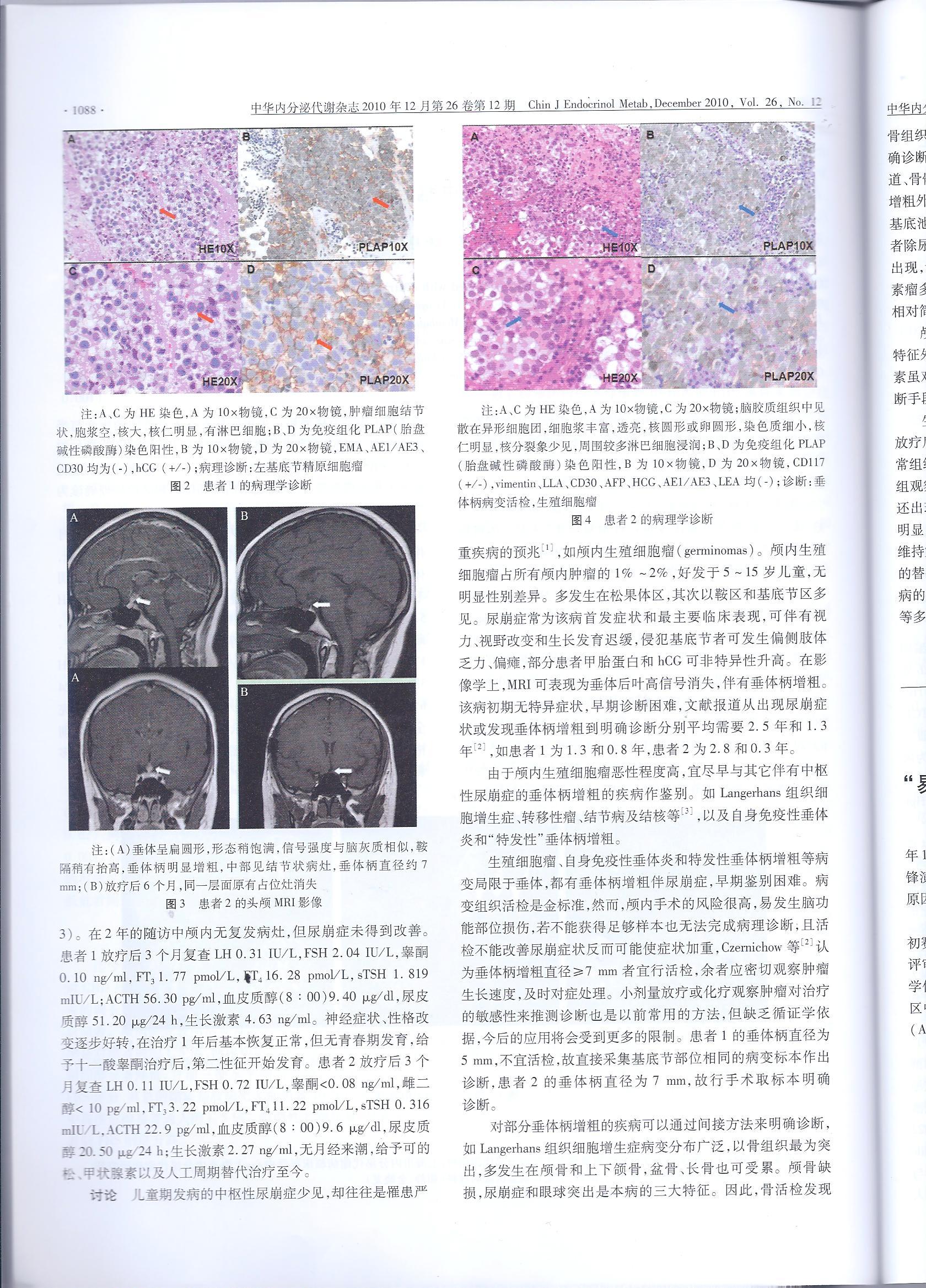 好大夫在线 孙首悦 > 颅内生殖细胞瘤所致垂体柄增粗伴中枢性尿崩症两