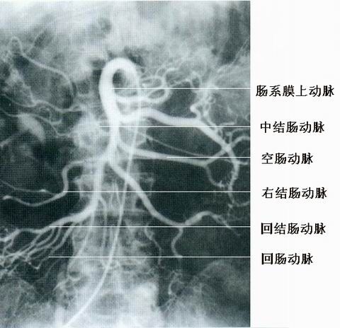 ct扫描 ct动静脉造影 在增强和灌注动态图上可显示肠系膜上动脉血栓