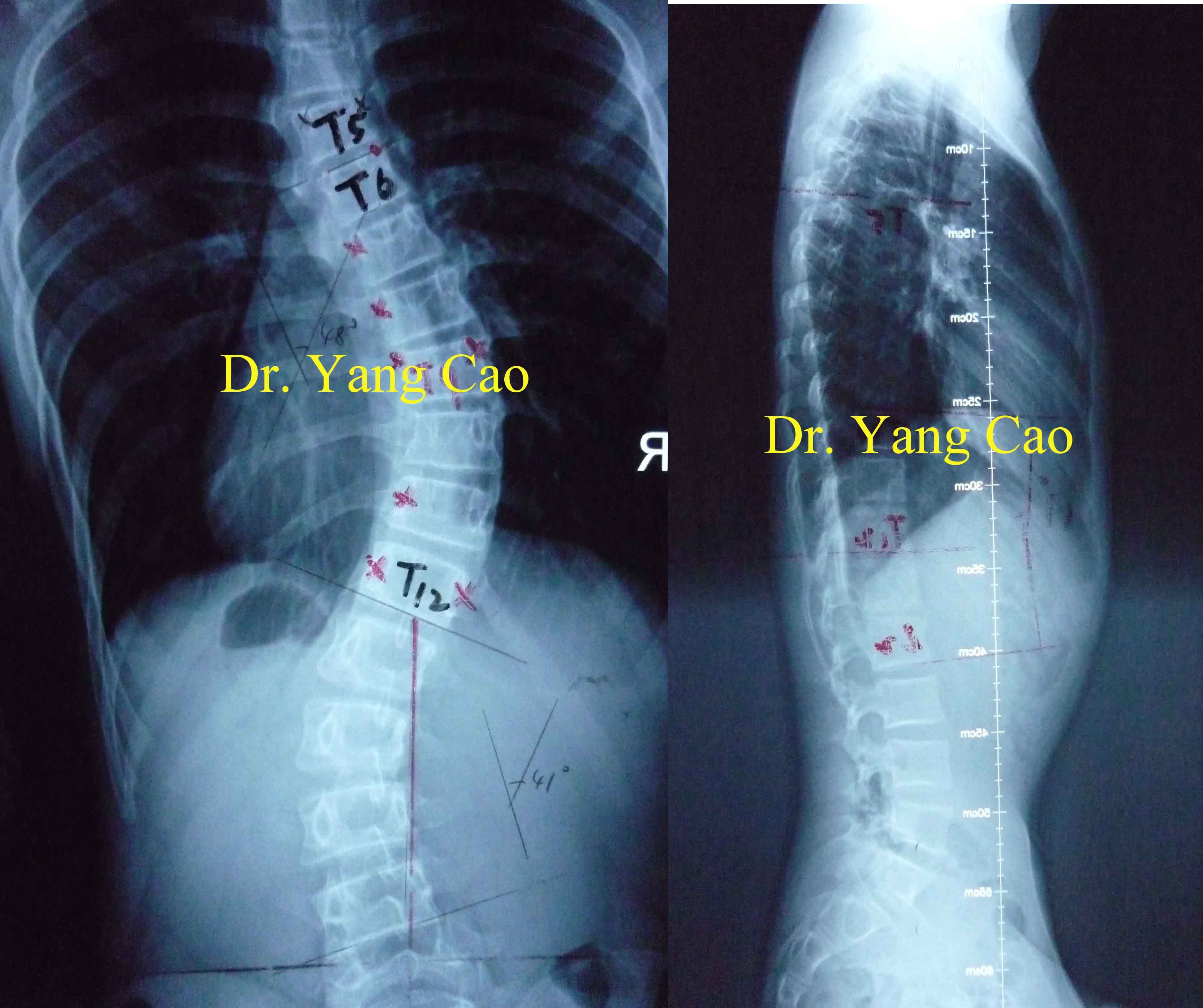 脊柱侧弯典型病例(3) - 好大夫在线