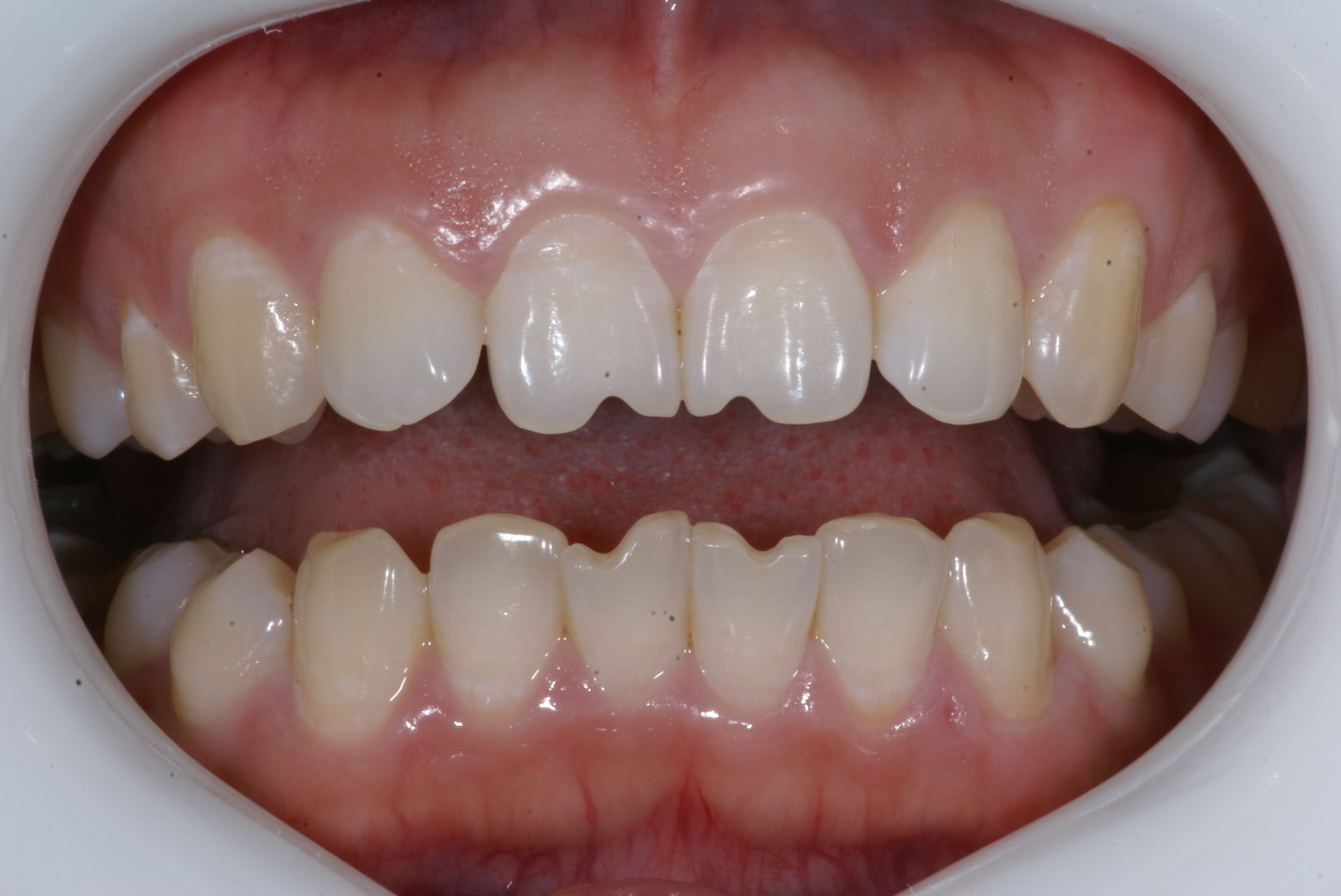 瓜子豁的病例我有发过吗?这个比较典型