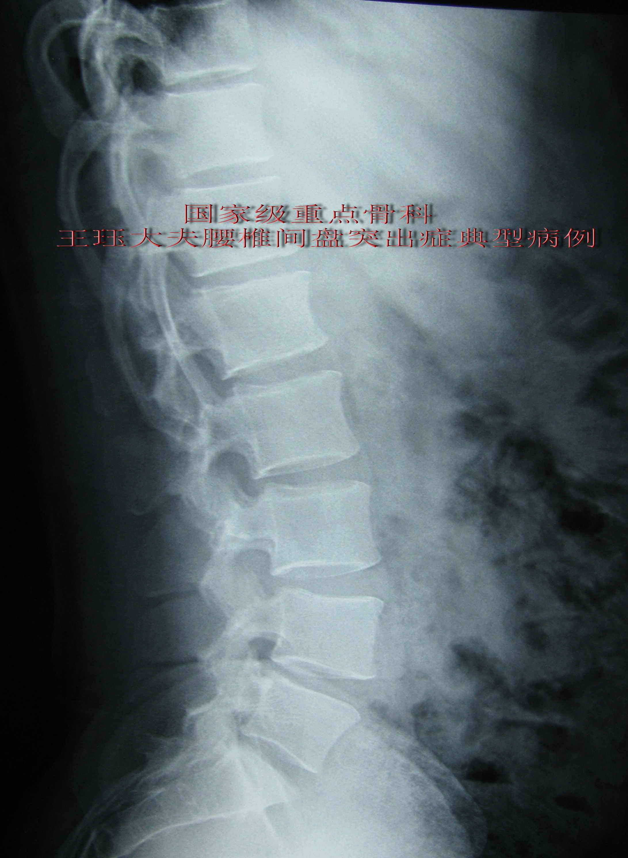 腰间盘突出片子 20岁图片