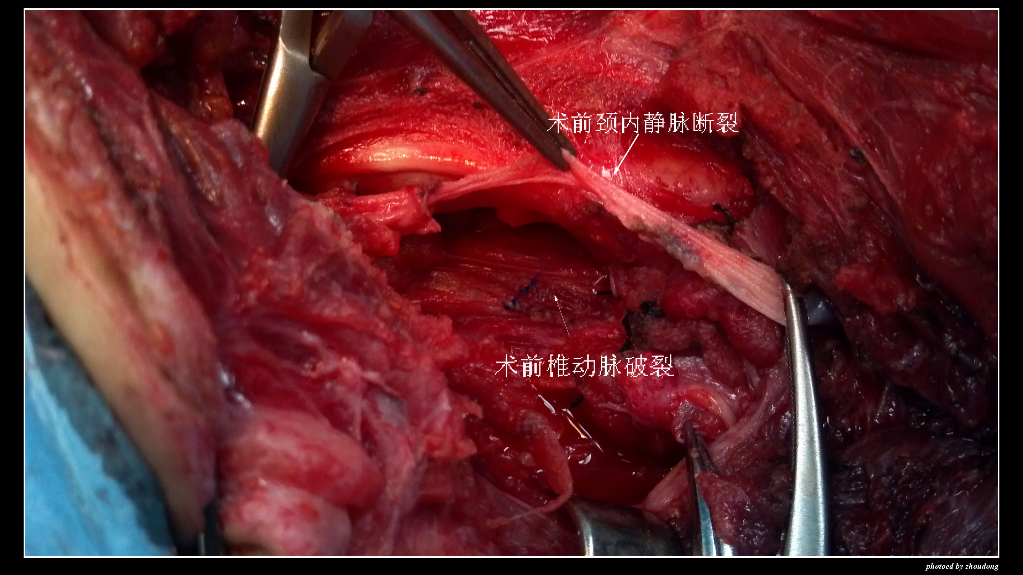 为生命搭建绿色通道---记兰大二院血管外科抢救颈部刀刺伤并大出血