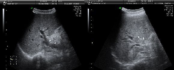 胆管癌超声图片