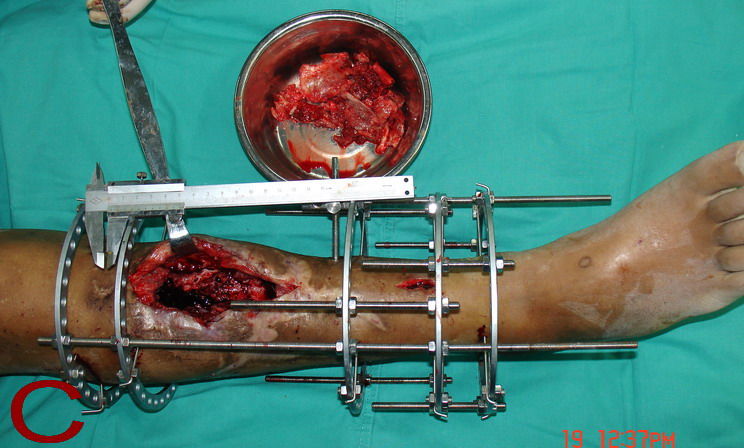 锯腿手术图片