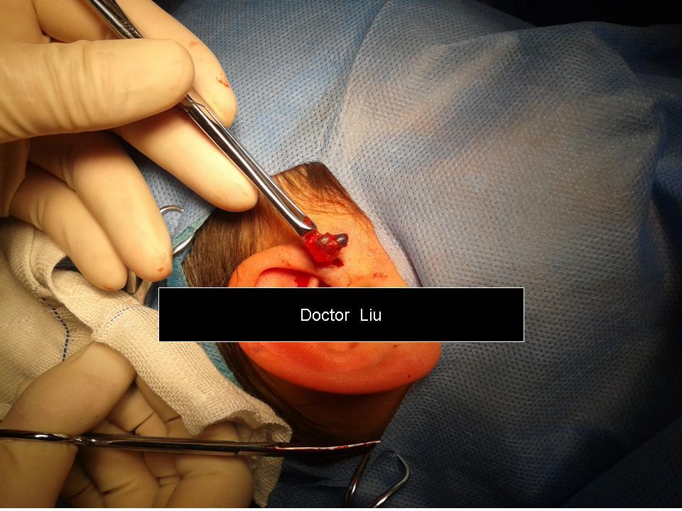 耳膜穿孔手术图片图片