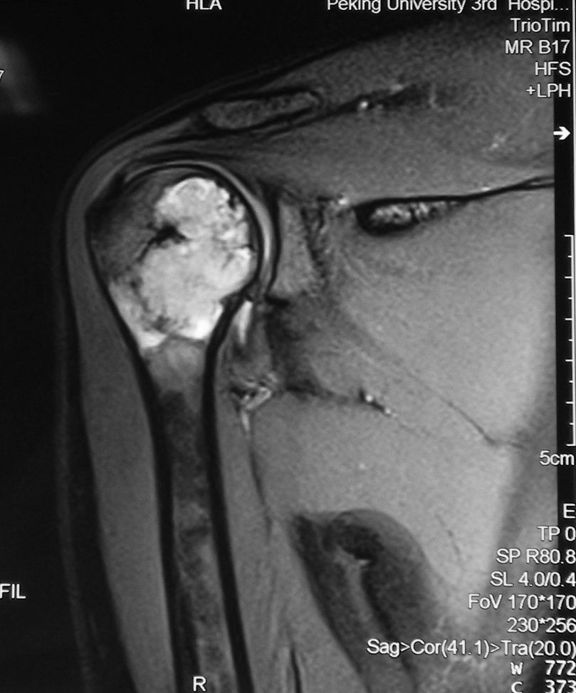 肩关节肿瘤行肩关节置换
