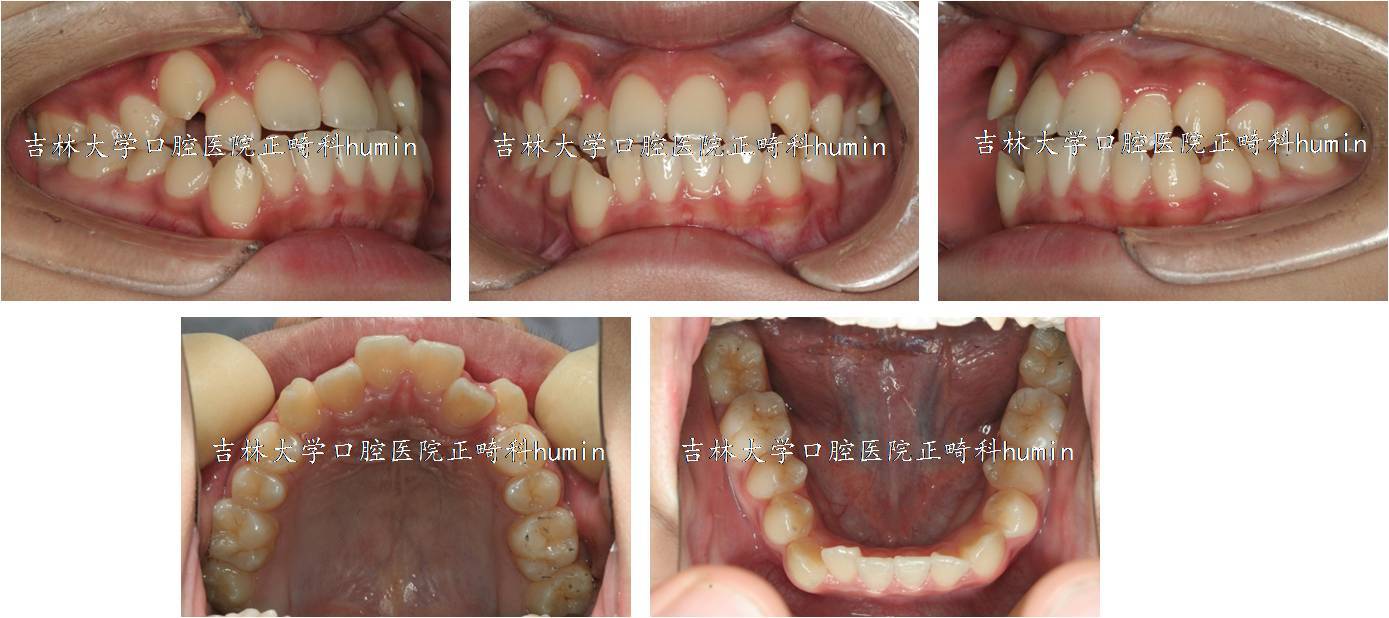 拔除4個第一前磨牙經矯治後