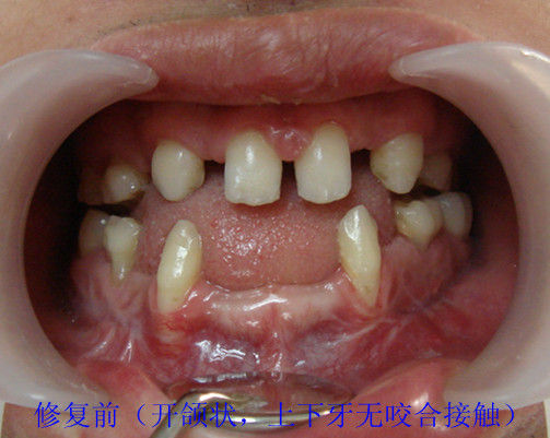 病例图片三:先天性缺牙修复
