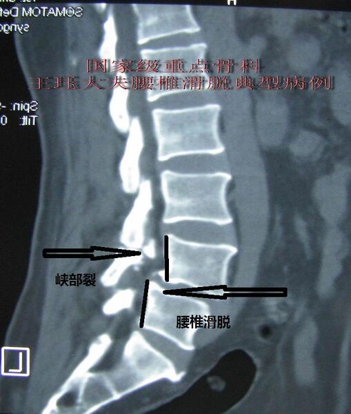 腰椎滑脱x线诊断图片