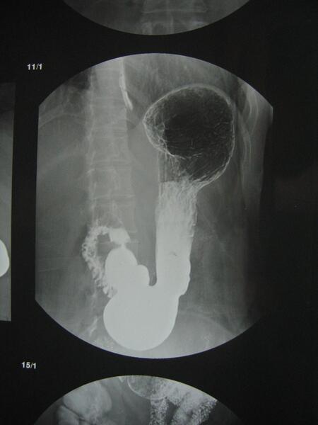 胃下垂检查图片图片