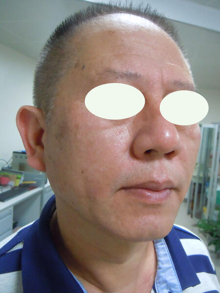 涎腺镜无创治疗慢性阻塞性腮腺炎2(有图片)