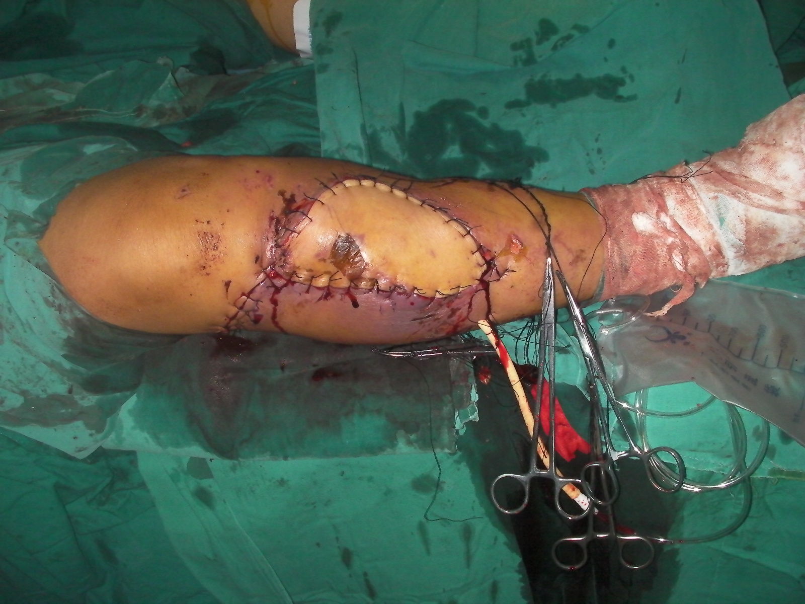 复杂胫骨平台骨折伴软组织损伤一期orif腓肠肌内侧头肌皮瓣转移手术