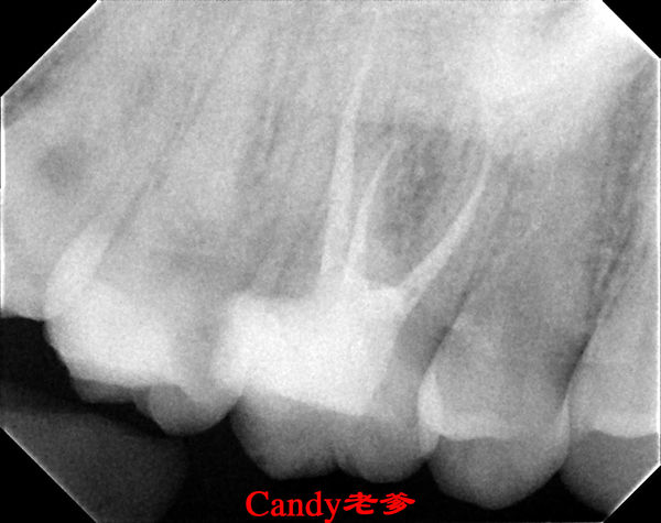 什么是根管治疗?