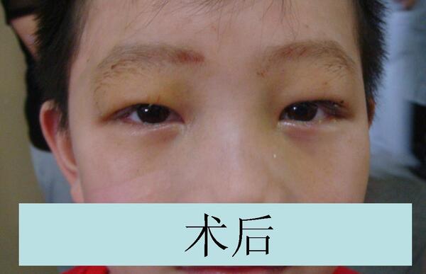 图片病例1—上睑下垂—儿童双侧先天性上睑下垂(额肌悬吊术) 