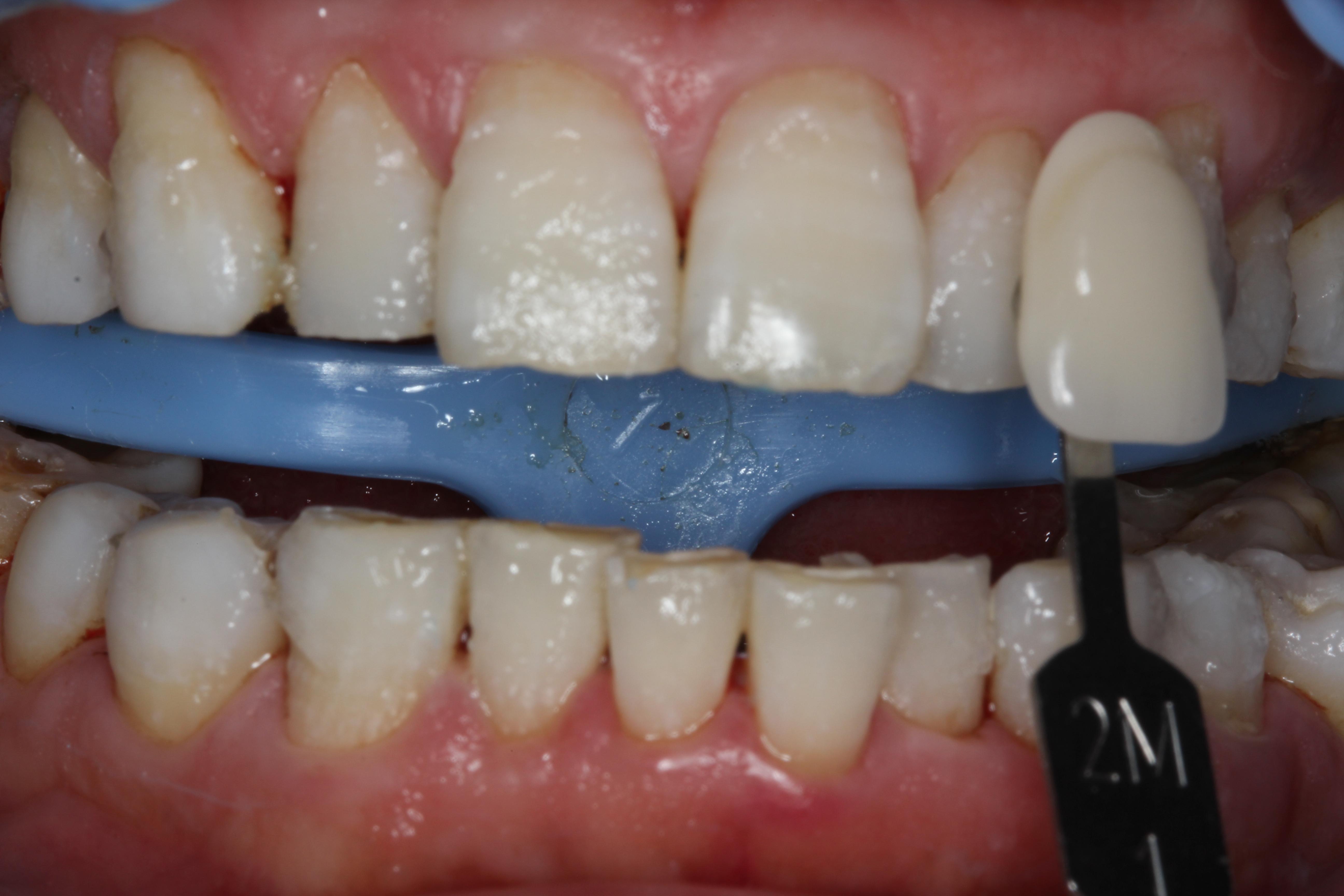 黄染色牙美白前后照片 - 好大夫在线