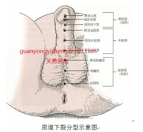 女性尿道下裂症状图片图片