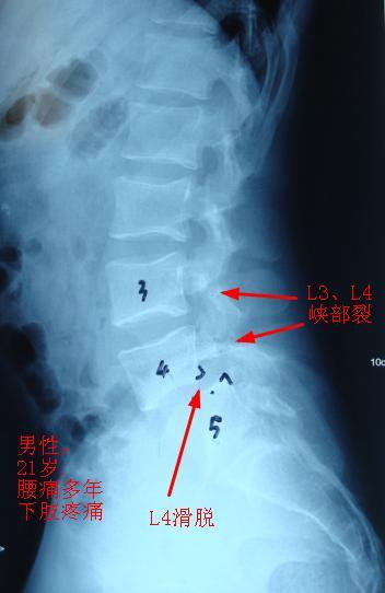 腰椎峡部裂治疗图片