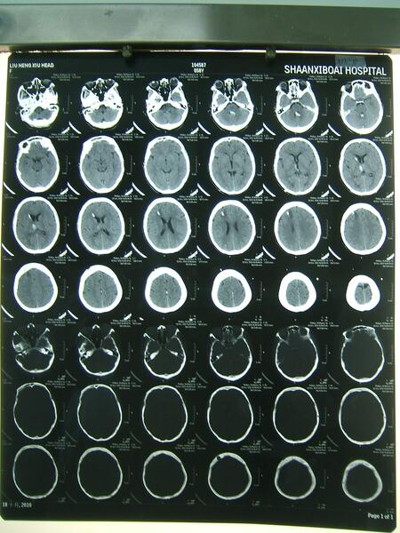 脑室系统出血行侧脑室引流术后ct表现 