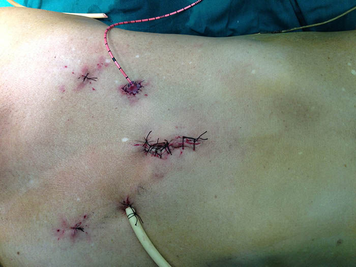 病例分享-全腹腔镜下左肾输尿管全长,膀胱根治性切除术 右侧输尿管