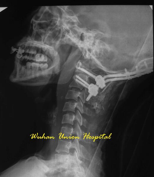 头颈部畸形伴脊髓腹侧受压 经口腔减压 二 好大夫在线