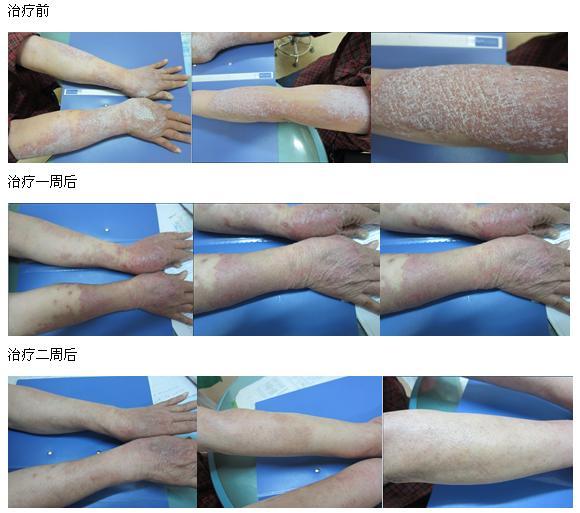 空气负离子喷雾联合外用药治疗慢性肥厚性湿疹1例 - 好大夫在线