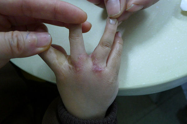 双翼皮瓣成形指蹼-——并指不植皮或减少植皮的新方法 - 好大夫在线