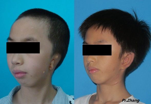 谈谈儿童第一 二腮弓综合症的早期综合治疗问题