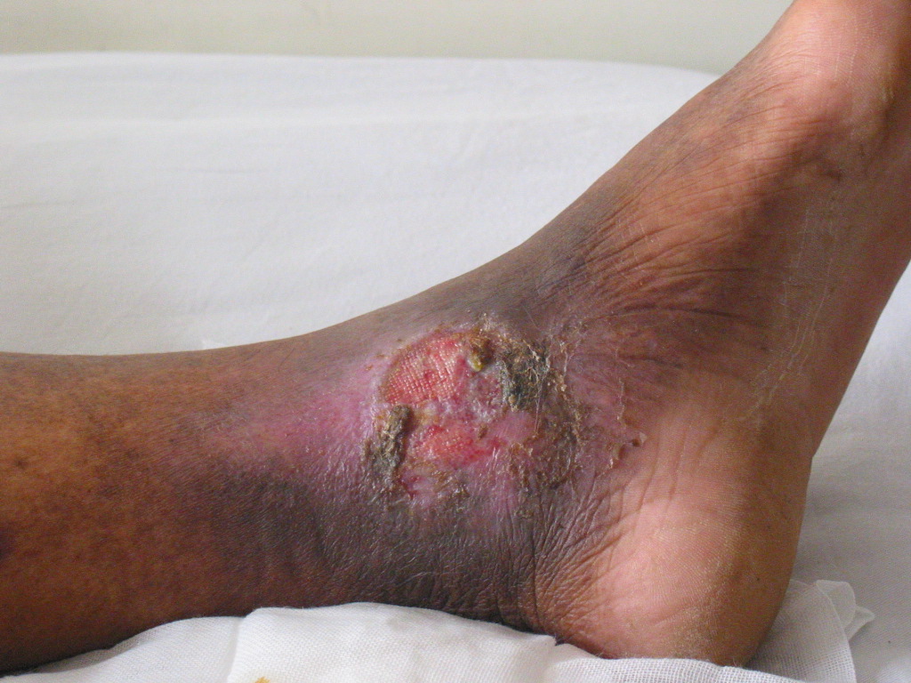 静脉性溃疡典型图片