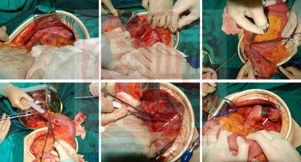 乙状结肠癌手术步骤图图片
