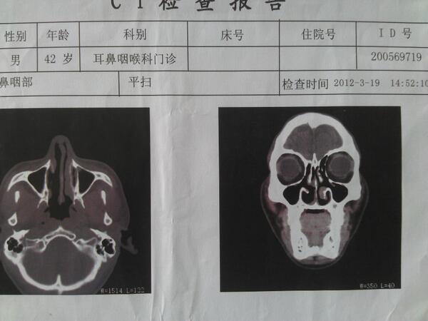 外院鼻竇ct示右側下鼻甲部分殘缺,雙側上頜竇,篩竇未見明顯的炎症改變