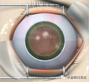 人工晶状体悬吊固定术 - 好大夫在线