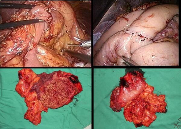 診治經過:入院後完善檢查,行腹腔鏡殘胃癌根治,全胃切除,roux-en-y
