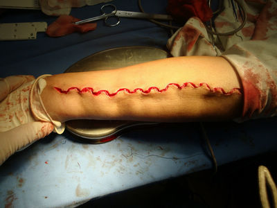 小烟疤 大智慧 - 好大夫在线