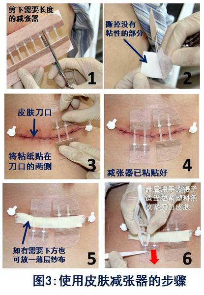手术后不留疤? 减少刀口张力很关键! 具体操作方法(图)