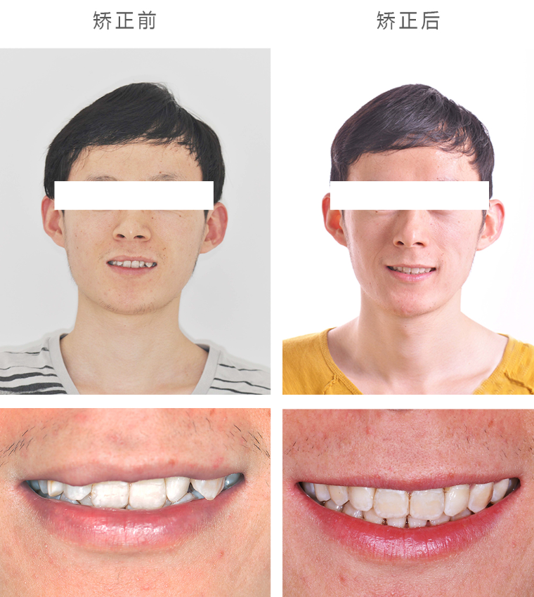 牙齿矫正前后对比矫正效果:小吴矫正牙齿后,牙列排齐整平,中线对正,上