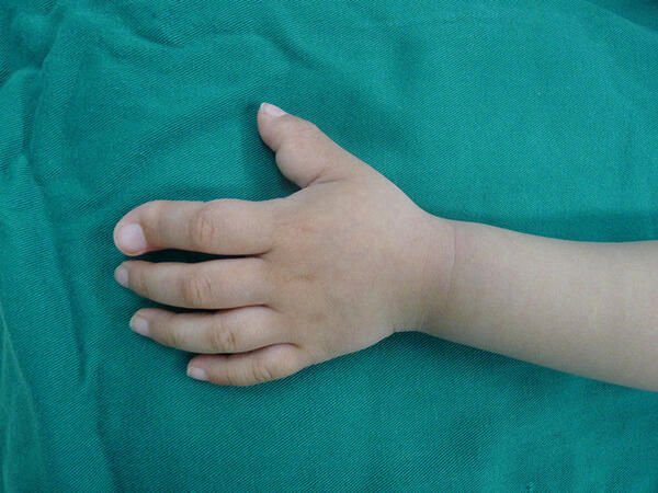 巨指(趾)症概述及手术实例