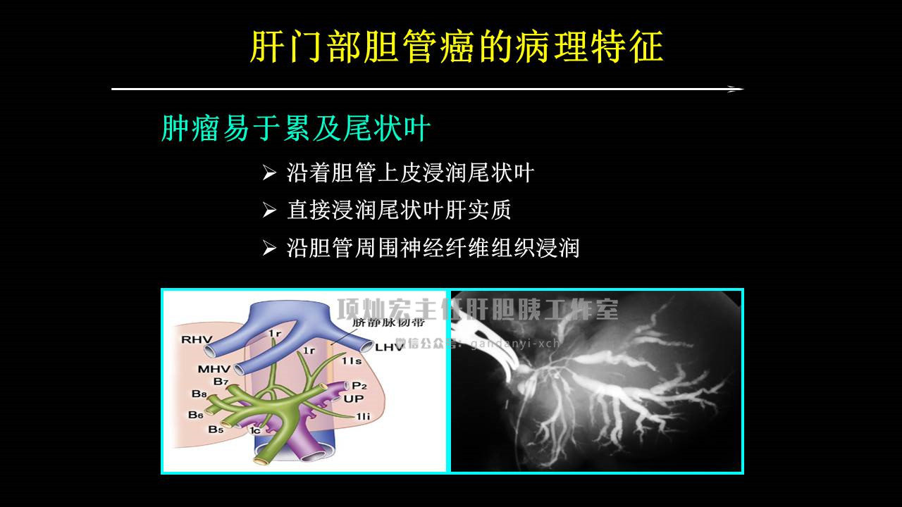 肝門部膽管癌手術治療案例——第十屆外科腫瘤學論壇 - 好大夫在線