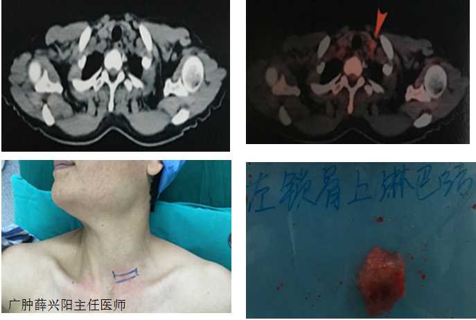 我科開展的有效肺癌診斷方法之一——鎖骨上淋巴結活檢手術(廣州醫科