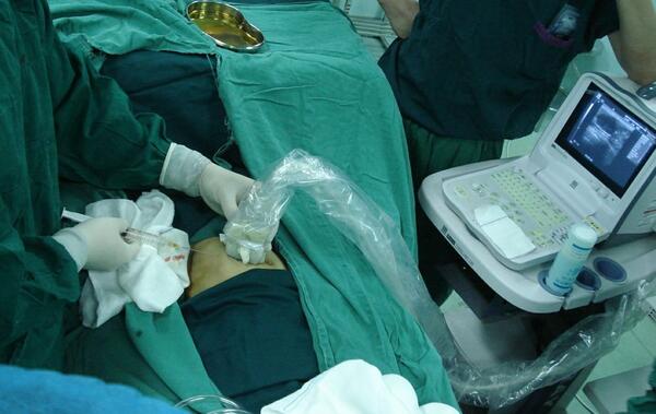 超声引导麻醉,定位 腔镜在小切口乳腺肿块切除中的应用2