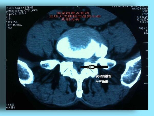 病例63腰椎間盤突出與椎管狹窄的區別是什麼