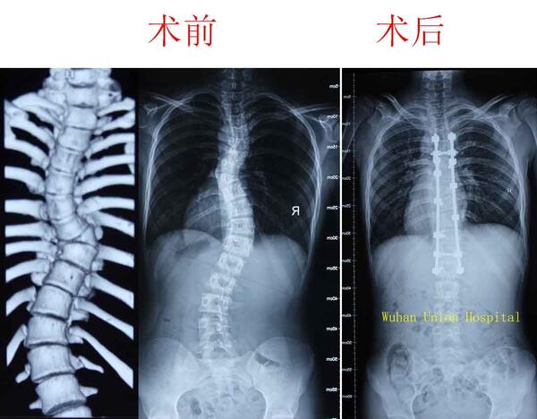 脊柱侧弯典型病例(20)——先天性脊柱侧弯