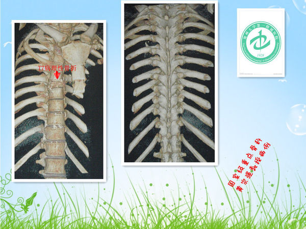 t7椎体肿瘤的整块切除 - 好大夫在线