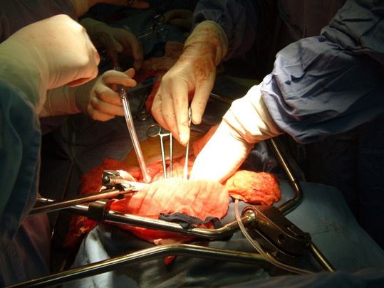 胰腺癌是恶性程度很高的消化系统肿瘤,占恶性肿瘤的1%-2%,为近几年