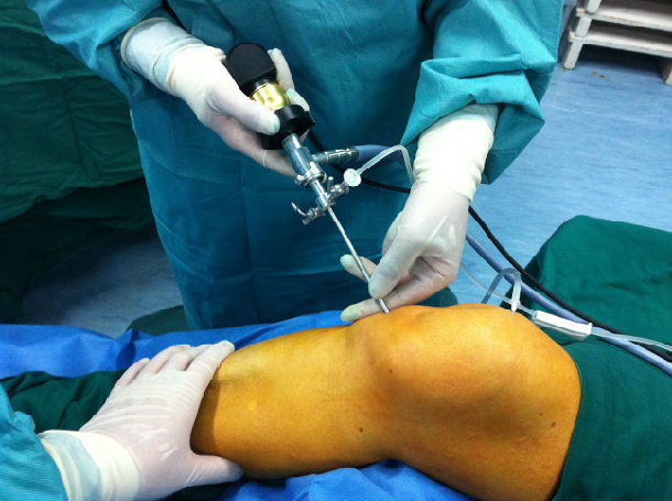 中医针刀镜疗法-----关节痛患者的福音